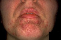 gyulladásos bőrbetegségek vörös pikkelyes foltok az arcon és a szemhéjon
