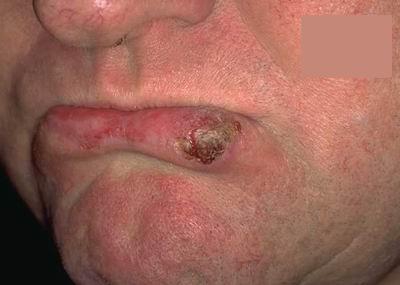 Epithelioma bőrrák, Intraductalis papilloma beteg uk