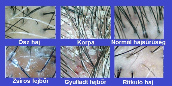 fejbőrproblémák vörös foltok hámlanak