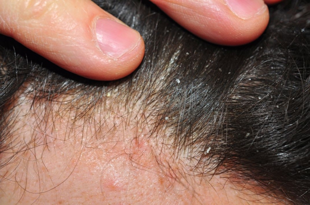 gombás fejbőr tünetei