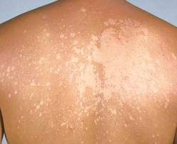 Bőrgomba, gombás bőrfertőzés: tünetei, oka és kezelése - EgészségKalauz