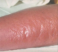 gennyes bőrbetegség