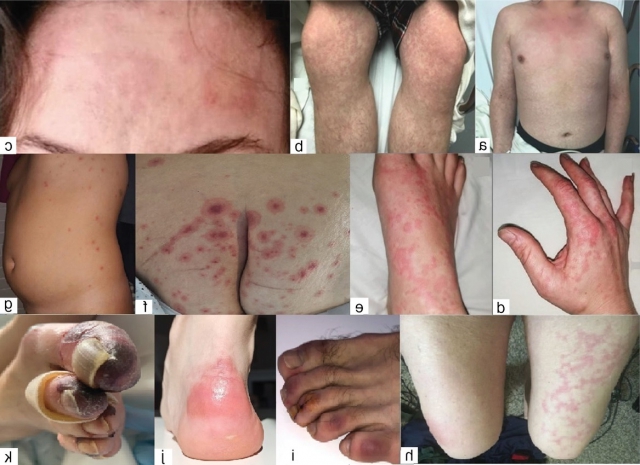 Bőrkiütések COVID-19 fertőzésben