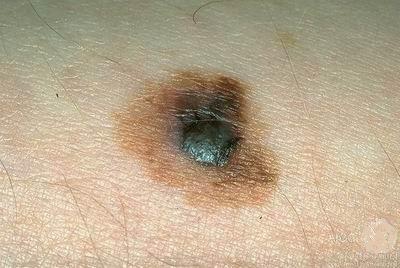 A melanoma