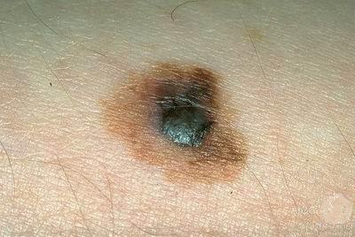 Bőrrák: basalioma, spinalioma, melanoma